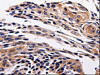 The image is immunohistochemistry of paraffin-embedded Human cervical cancer tissue using CSB-PA038144 (ADRB1 Antibody) at dilution 1/25. (Original magnification: ×200)