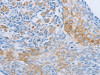 The image on the left is immunohistochemistry of paraffin-embedded Human cervical cancer tissue using CSB-PA779661 (ADRB3 Antibody) at dilution 1/60, on the right is treated with synthetic peptide. (Original magnification: ×200)