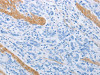 The image on the left is immunohistochemistry of paraffin-embedded Human gastic cancer tissue using CSB-PA120361 (ADRB3 Antibody) at dilution 1/20, on the right is treated with synthetic peptide. (Original magnification: ×200)