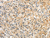 The image on the left is immunohistochemistry of paraffin-embedded Human prostate cancer tissue using CSB-PA578011 (Rab17 Antibody) at dilution 1/30, on the right is treated with synthetic peptide. (Original magnification: ×200)