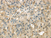 The image on the left is immunohistochemistry of paraffin-embedded Human breast cancer tissue using CSB-PA239298 (RAB17 Antibody) at dilution 1/40, on the right is treated with synthetic peptide. (Original magnification: ×200)