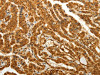 The image on the left is immunohistochemistry of paraffin-embedded Human thyroid cancer tissue using CSB-PA990609 (RAB26 Antibody) at dilution 1/80, on the right is treated with synthetic peptide. (Original magnification: ×200)