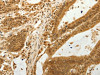 The image on the left is immunohistochemistry of paraffin-embedded Human colon cancer tissue using CSB-PA990609 (RAB26 Antibody) at dilution 1/80, on the right is treated with synthetic peptide. (Original magnification: ×200)