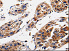 The image is immunohistochemistry of paraffin-embedded Human gastic cancer tissue using CSB-PA419638 (RAB41 Antibody) at dilution 1/60. (Original magnification: ×200) The image is immunohistochemistry of paraffin-embedded Human gastic cancer tissue using CSB-PA419638 (RAB41 Antibody) at dilution 1/60. (Original magnification: ×200)