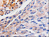 The image is immunohistochemistry of paraffin-embedded Human liver cancer tissue using CSB-PA419638 (RAB41 Antibody) at dilution 1/60. (Original magnification: ×200) The image is immunohistochemistry of paraffin-embedded Human liver cancer tissue using CSB-PA419638 (RAB41 Antibody) at dilution 1/60. (Original magnification: ×200)