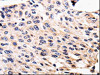 The image is immunohistochemistry of paraffin-embedded Human cervical cancer tissue using CSB-PA847171 (ALK Antibody) at dilution 1/25. (Original magnification: ×200)