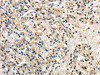 The image on the left is immunohistochemistry of paraffin-embedded Human prostate cancer tissue using CSB-PA902487 (GPT Antibody) at dilution 1/30, on the right is treated with synthetic peptide. (Original magnification: ×200)