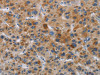 The image on the left is immunohistochemistry of paraffin-embedded Human liver cancer tissue using CSB-PA442564 (IAPP Antibody) at dilution 1/40, on the right is treated with synthetic peptide. (Original magnification: ×200)