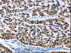 The image on the left is immunohistochemistry of paraffin-embedded Human lung cancer tissue using CSB-PA928455 (AP1B1 Antibody) at dilution 1/25, on the right is treated with synthetic peptide. (Original magnification: ×200)