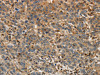 The image on the left is immunohistochemistry of paraffin-embedded Human liver cancer tissue using CSB-PA129669 (ARF6 Antibody) at dilution 1/30, on the right is treated with synthetic peptide. (Original magnification: ×200)