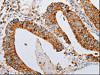 The image on the left is immunohistochemistry of paraffin-embedded Human colon cancer tissue using CSB-PA088834 (ARF6 Antibody) at dilution 1/15, on the right is treated with synthetic peptide. (Original magnification: ×200)