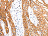 The image on the left is immunohistochemistry of paraffin-embedded Human esophagus cancer tissue using CSB-PA955238 (Rab3D Antibody) at dilution 1/27, on the right is treated with synthetic peptide. (Original magnification: ×200)