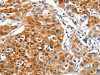 The image on the left is immunohistochemistry of paraffin-embedded Human lung cancer tissue using CSB-PA796881 (GNAZ Antibody) at dilution 1/25, on the right is treated with synthetic peptide. (Original magnification: ×200)