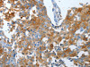 The image on the left is immunohistochemistry of paraffin-embedded Human breast cancer tissue using CSB-PA808676 (LOX Antibody) at dilution 1/25, on the right is treated with synthetic peptide. (Original magnification: ×200)