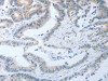 The image on the left is immunohistochemistry of paraffin-embedded Human colon cancer tissue using CSB-PA808676 (LOX Antibody) at dilution 1/25, on the right is treated with synthetic peptide. (Original magnification: ×200)