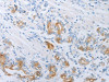 The image on the left is immunohistochemistry of paraffin-embedded Human gastric cancer tissue using CSB-PA130669 (LOX Antibody) at dilution 1/30, on the right is treated with synthetic peptide. (Original magnification: ×200)