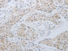 The image on the left is immunohistochemistry of paraffin-embedded Human lung cancer tissue using CSB-PA061510 (LOX Antibody) at dilution 1/30, on the right is treated with synthetic peptide. (Original magnification: ×200)
