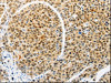 The image on the left is immunohistochemistry of paraffin-embedded Human liver cancer tissue using CSB-PA558089 (RAN Antibody) at dilution 1/10, on the right is treated with synthetic peptide. (Original magnification: ×200)