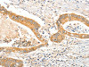 The image on the left is immunohistochemistry of paraffin-embedded Human colon cancer tissue using CSB-PA780260 (APOB Antibody) at dilution 1/15, on the right is treated with synthetic peptide. (Original magnification: ×200)