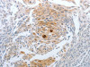 The image on the left is immunohistochemistry of paraffin-embedded Human cervical cancer tissue using CSB-PA205008 (CST3 Antibody) at dilution 1/20, on the right is treated with synthetic peptide. (Original magnification: ×200)