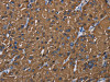 The image on the left is immunohistochemistry of paraffin-embedded Human liver cancer tissue using CSB-PA901137 (BMP3 Antibody) at dilution 1/20, on the right is treated with synthetic peptide. (Original magnification: ×200)