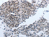 The image on the left is immunohistochemistry of paraffin-embedded Human liver cancer tissue using CSB-PA090777 (NPR1 Antibody) at dilution 1/40, on the right is treated with synthetic peptide. (Original magnification: ×200)