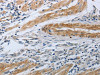 The image on the left is immunohistochemistry of paraffin-embedded Human gastric cancer tissue using CSB-PA934625 (NPR1 Antibody) at dilution 1/30, on the right is treated with synthetic peptide. (Original magnification: ×200)