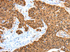 The image on the left is immunohistochemistry of paraffin-embedded Human esophagus cancer tissue using CSB-PA925454 (ADAMTS5 Antibody) at dilution 1/30, on the right is treated with synthetic peptide. (Original magnification: ×200)