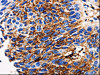 The image on the left is immunohistochemistry of paraffin-embedded Human lung cancer tissue using CSB-PA198249 (ADAMTS5 Antibody) at dilution 1/10, on the right is treated with synthetic peptide. (Original magnification: ×200)