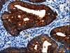 The image on the left is immunohistochemistry of paraffin-embedded Human cervical cancer tissue using CSB-PA920513 (BIRC6 Antibody) at dilution 1/7, on the right is treated with synthetic peptide. (Original magnification: ×200)