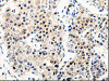 The image on the left is immunohistochemistry of paraffin-embedded Human liver cancer tissue using CSB-PA123968 (APP Antibody) at dilution 1/100, on the right is treated with synthetic peptide. (Original magnification: ×200)