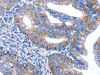 The image on the left is immunohistochemistry of paraffin-embedded Human cervical cancer tissue using CSB-PA056943 (AR Antibody) at dilution 1/20, on the right is treated with synthetic peptide. (Original magnification: ×200)