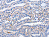 The image on the left is immunohistochemistry of paraffin-embedded Human thyroid cancer tissue using CSB-PA056943 (AR Antibody) at dilution 1/20, on the right is treated with synthetic peptide. (Original magnification: ×200)