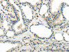The image on the left is immunohistochemistry of paraffin-embedded Human thyroid cancer tissue using CSB-PA066718 (CYP19A1 Antibody) at dilution 1/30, on the right is treated with synthetic peptide. (Original magnification: ×200)