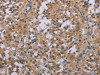 The image on the left is immunohistochemistry of paraffin-embedded Human thyroid cancer tissue using CSB-PA104519 (ACVR2A Antibody) at dilution 1/20, on the right is treated with synthetic peptide. (Original magnification: ×200)