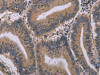 The image on the left is immunohistochemistry of paraffin-embedded Human colon cancer tissue using CSB-PA055681 (ACVR2A Antibody) at dilution 1/20, on the right is treated with synthetic peptide. (Original magnification: ×200)