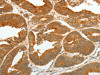 The image on the left is immunohistochemistry of paraffin-embedded Human colon cancer tissue using CSB-PA796684 (ASCL1 Antibody) at dilution 1/30, on the right is treated with synthetic peptide. (Original magnification: ×200)
