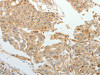 The image on the left is immunohistochemistry of paraffin-embedded Human lung cancer tissue using CSB-PA796684 (ASCL1 Antibody) at dilution 1/30, on the right is treated with synthetic peptide. (Original magnification: ×200)