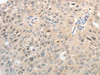 The image on the left is immunohistochemistry of paraffin-embedded Human ovarian cancer tissue using CSB-PA298683 (ASCL1 Antibody) at dilution 1/30, on the right is treated with synthetic peptide. (Original magnification: ×200)