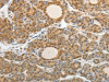 The image on the left is immunohistochemistry of paraffin-embedded Human thyroid cancer tissue using CSB-PA298683 (ASCL1 Antibody) at dilution 1/30, on the right is treated with synthetic peptide. (Original magnification: ×200)