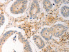 The image on the left is immunohistochemistry of paraffin-embedded Human colon cancer tissue using CSB-PA987235 (AVPR2 Antibody) at dilution 1/30, on the right is treated with synthetic peptide. (Original magnification: ×200)