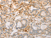 The image on the left is immunohistochemistry of paraffin-embedded Human gastric cancer tissue using CSB-PA987235 (AVPR2 Antibody) at dilution 1/30, on the right is treated with synthetic peptide. (Original magnification: ×200)