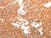 The image on the left is immunohistochemistry of paraffin-embedded Human breast cancer tissue using CSB-PA574868 (BDKRB2 Antibody) at dilution 1/30, on the right is treated with synthetic peptide. (Original magnification: ×200)