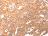 The image on the left is immunohistochemistry of paraffin-embedded Human ovarian cancer tissue using CSB-PA574868 (BDKRB2 Antibody) at dilution 1/30, on the right is treated with synthetic peptide. (Original magnification: ×200)