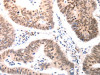 The image on the left is immunohistochemistry of paraffin-embedded Human colon cancer tissue using CSB-PA031026 (BDKRB2 Antibody) at dilution 1/50, on the right is treated with synthetic peptide. (Original magnification: ×200)