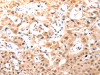 The image on the left is immunohistochemistry of paraffin-embedded Human lung cancer tissue using CSB-PA031026 (BDKRB2 Antibody) at dilution 1/50, on the right is treated with synthetic peptide. (Original magnification: ×200)