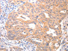 The image on the left is immunohistochemistry of paraffin-embedded Human ovarian cancer tissue using CSB-PA017573 (VTCN1 Antibody) at dilution 1/20, on the right is treated with synthetic peptide. (Original magnification: ×200)