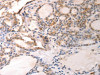The image on the left is immunohistochemistry of paraffin-embedded Human thyroid cancer tissue using CSB-PA017573 (VTCN1 Antibody) at dilution 1/20, on the right is treated with synthetic peptide. (Original magnification: ×200)