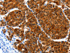 The image on the left is immunohistochemistry of paraffin-embedded Human liver cancer tissue using CSB-PA566343 (HIBADH Antibody) at dilution 1/25, on the right is treated with synthetic peptide. (Original magnification: ×200)