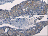 The image on the left is immunohistochemistry of paraffin-embedded Human breast cancer tissue using CSB-PA270018 (FGF2 Antibody) at dilution 1/50, on the right is treated with synthetic peptide. (Original magnification: ×200)